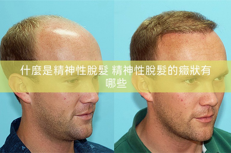 什麼是精神性脫髮 精神性脫髮的癥狀有哪些 什麼是精神性脫髮 精神性脫髮的癥狀有哪些