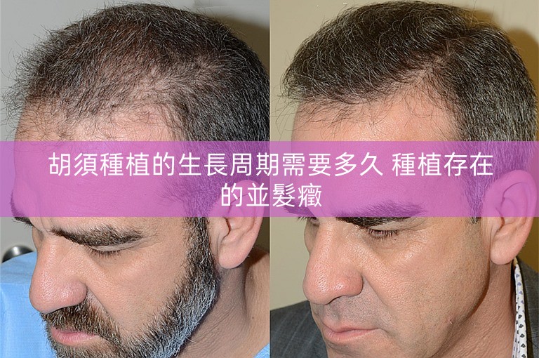 胡須種植的生長周期需要多久 種植存在的並髮癥