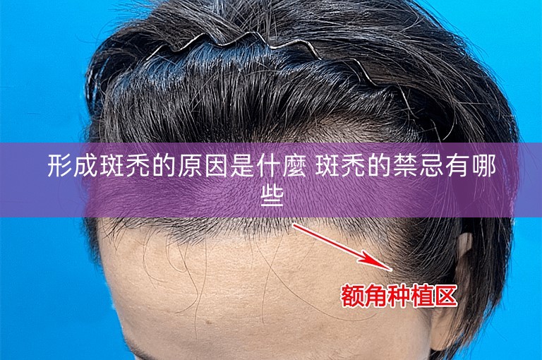 形成斑禿的原因是什麼 斑禿的禁忌有哪些