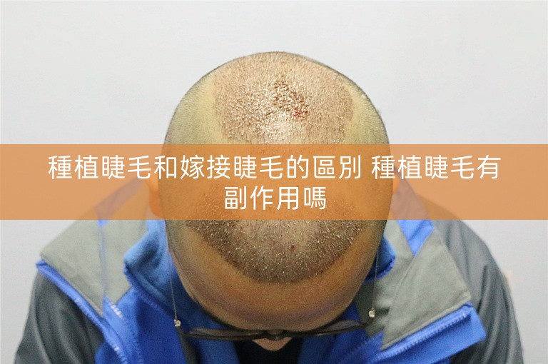 種植睫毛和嫁接睫毛的區別 種植睫毛有副作用嗎