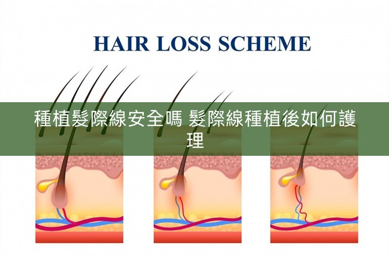 種植髮際線安全嗎 髮際線種植後如何護理