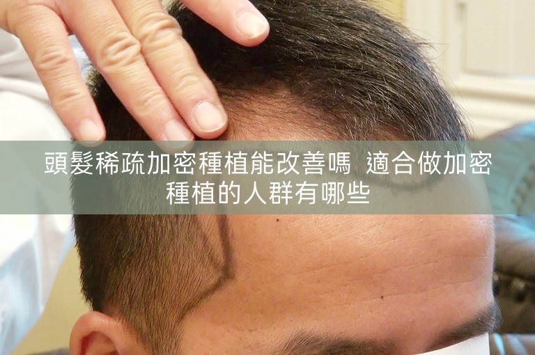 頭髮稀疏加密種植能改善嗎  適合做加密種植的人群有哪些