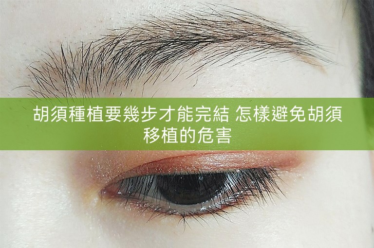 胡須種植要幾步才能完結 怎樣避免胡須移植的危害