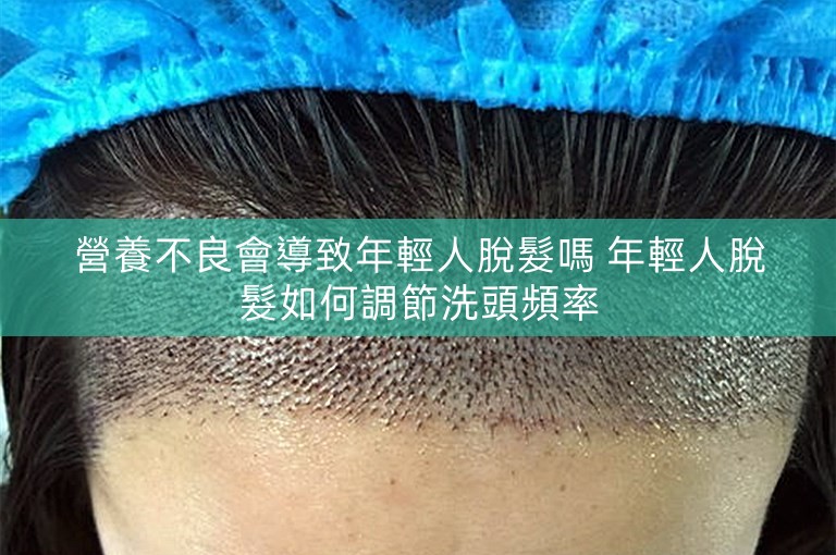 營養不良會導致年輕人脫髮嗎 年輕人脫髮如何調節洗頭頻率