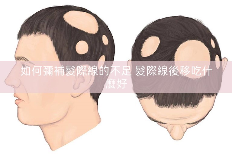 如何彌補髮際線的不足 髮際線後移吃什麼好