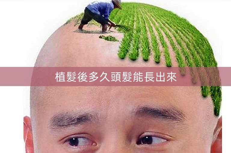 植髮後多久頭髮能長出來