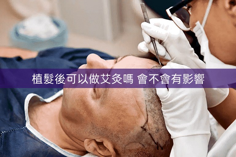 植髮後可以做艾灸嗎 會不會有影響