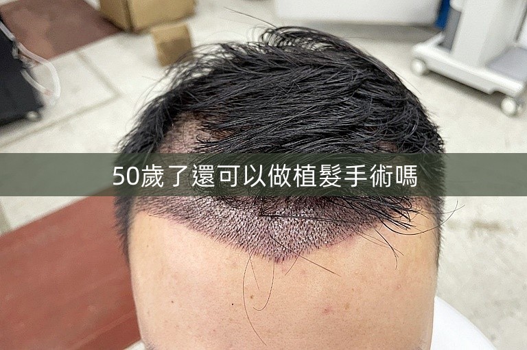 50歲了還可以做植髮手術嗎