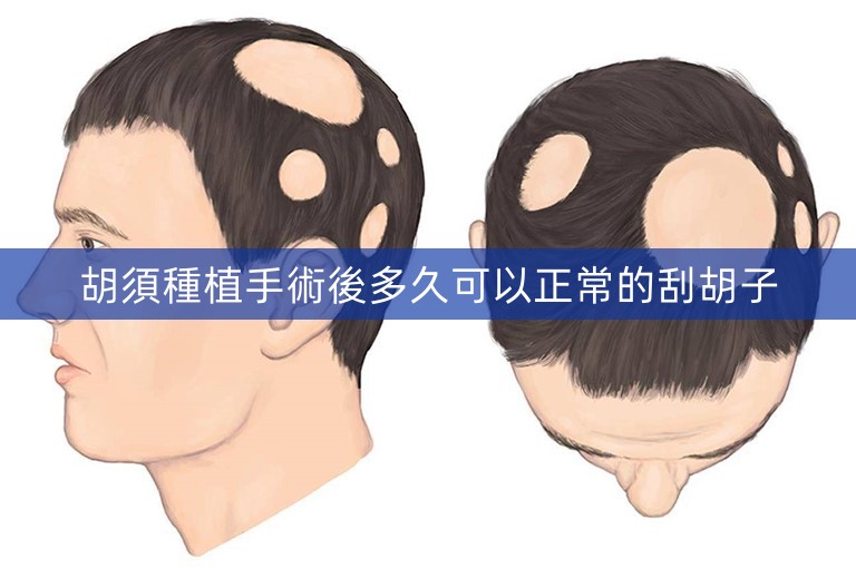 胡須種植手術後多久可以正常的刮胡子