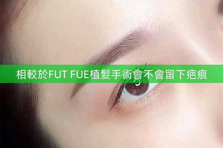 相較於FUT FUE植髮手術會不會留下疤痕