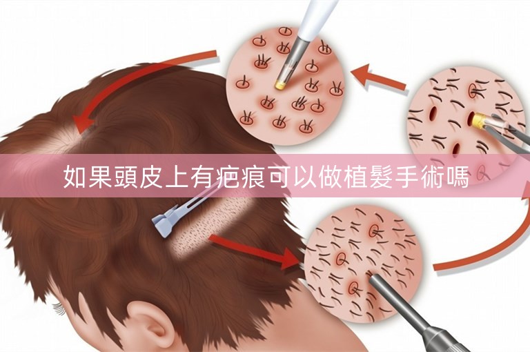 如果頭皮上有疤痕可以做植髮手術嗎