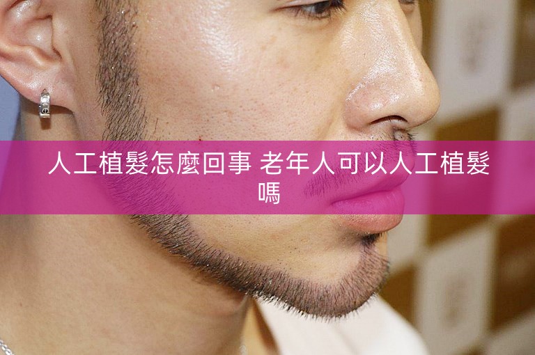 人工植髮怎麼回事 老年人可以人工植髮嗎