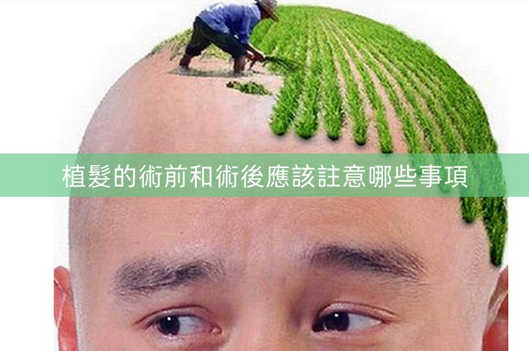 植髮的術前和術後應該註意哪些事項