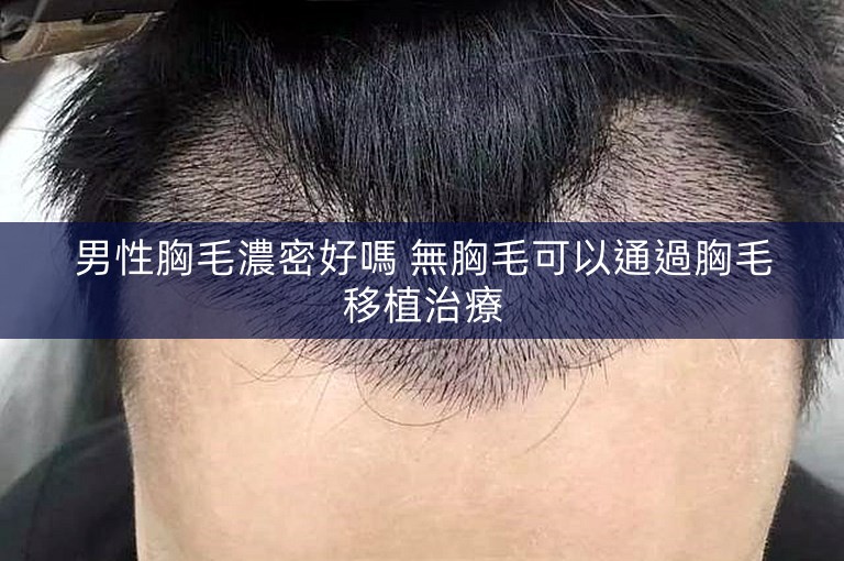 男性胸毛濃密好嗎 無胸毛可以通過胸毛移植治療