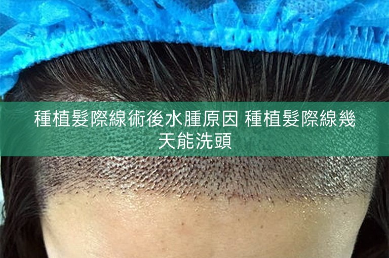 種植髮際線術後水腫原因 種植髮際線幾天能洗頭