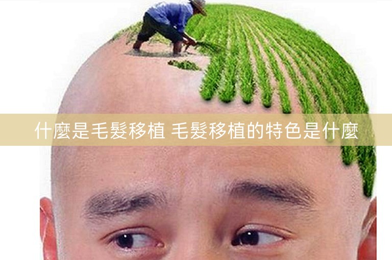 什麼是毛髮移植 毛髮移植的特色是什麼