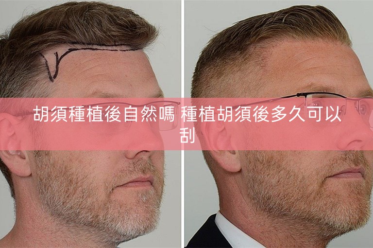 胡須種植後自然嗎 種植胡須後多久可以刮