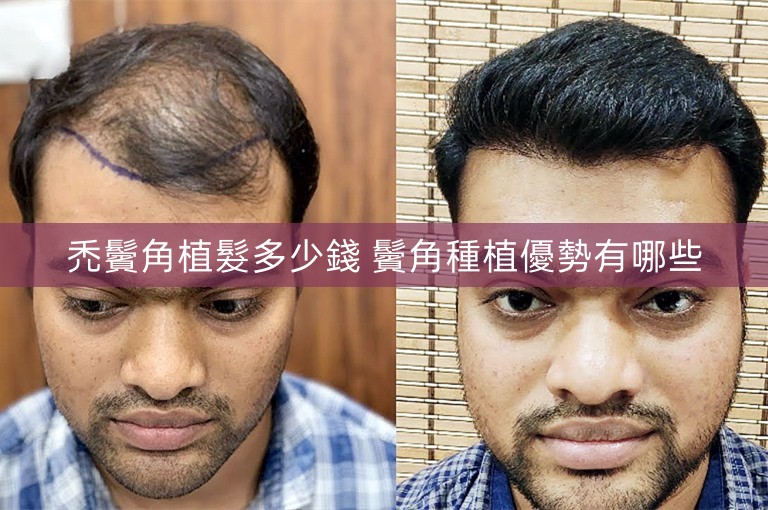 禿鬢角植髮多少錢 鬢角種植優勢有哪些