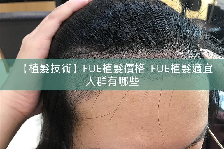 【植髮技術】FUE植髮價格  FUE植髮適宜人群有哪些