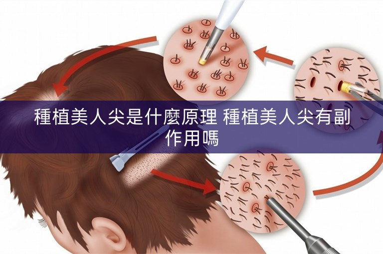 種植美人尖是什麼原理 種植美人尖有副作用嗎