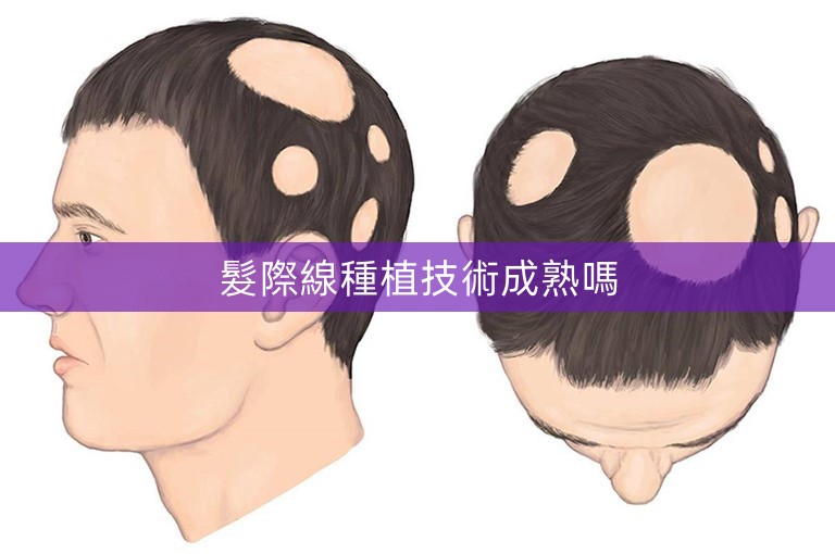 髮際線種植技術成熟嗎